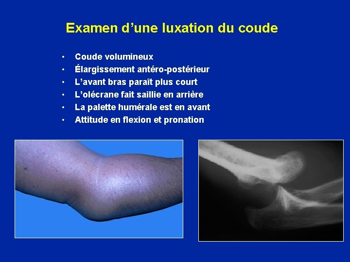 Examen d’une luxation du coude • • • Coude volumineux Élargissement antéro-postérieur L’avant bras