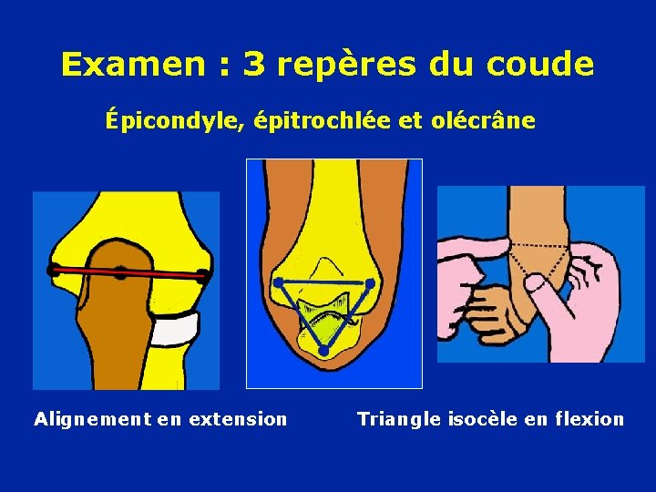 Examen : 3 repères du coude Épicondyle, épitrochlée et olécrâne Alignement en extension Triangle