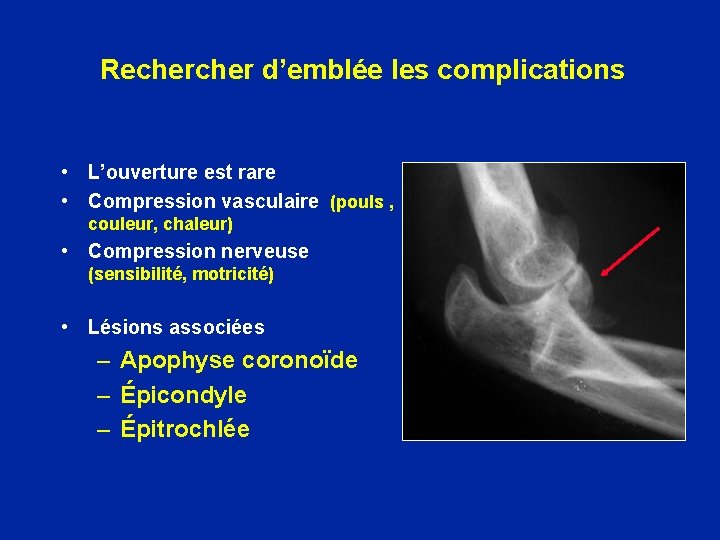 Recher d’emblée les complications • L’ouverture est rare • Compression vasculaire (pouls , couleur,