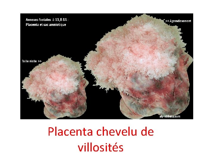 Placenta chevelu de villosités 