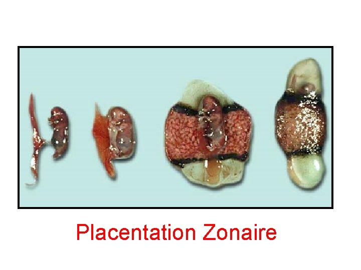 Placentation Zonaire 