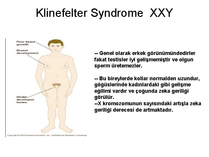 Klinefelter Syndrome XXY -- Genel olarak erkek görünümündedirler fakat testisler iyi gelişmemiştir ve olgun