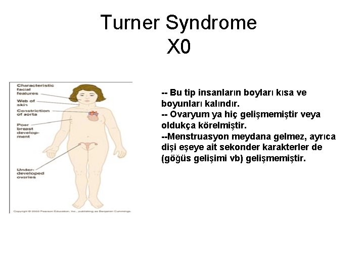 Turner Syndrome X 0 -- Bu tip insanların boyları kısa ve boyunları kalındır. --