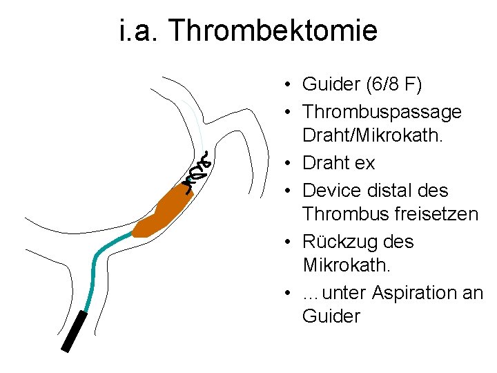 i. a. Thrombektomie • Guider (6/8 F) • Thrombuspassage Draht/Mikrokath. • Draht ex •