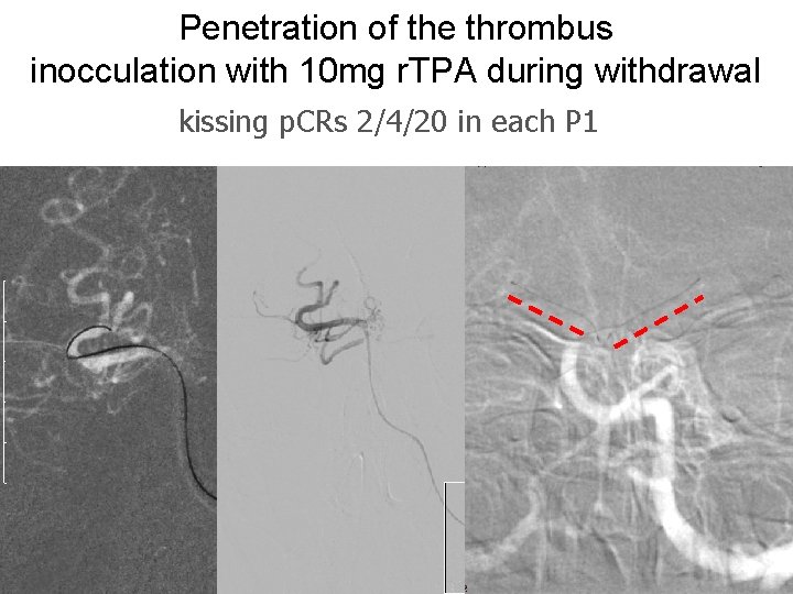Penetration of the thrombus inocculation with 10 mg r. TPA during withdrawal kissing p.