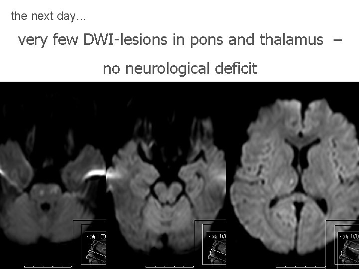 the next day… very few DWI-lesions in pons and thalamus – no neurological deficit