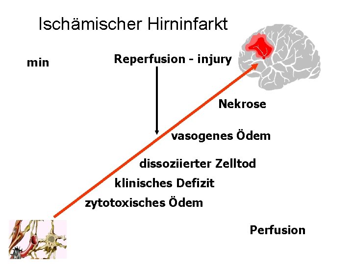 Ischämischer Hirninfarkt min Reperfusion - injury Nekrose vasogenes Ödem dissoziierter Zelltod klinisches Defizit zytotoxisches