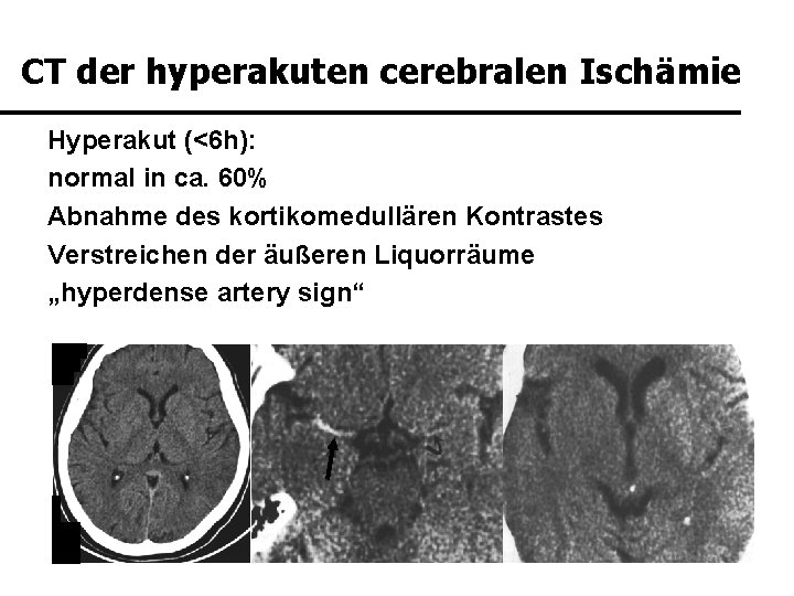 CT der hyperakuten cerebralen Ischämie Hyperakut (<6 h): normal in ca. 60% Abnahme des