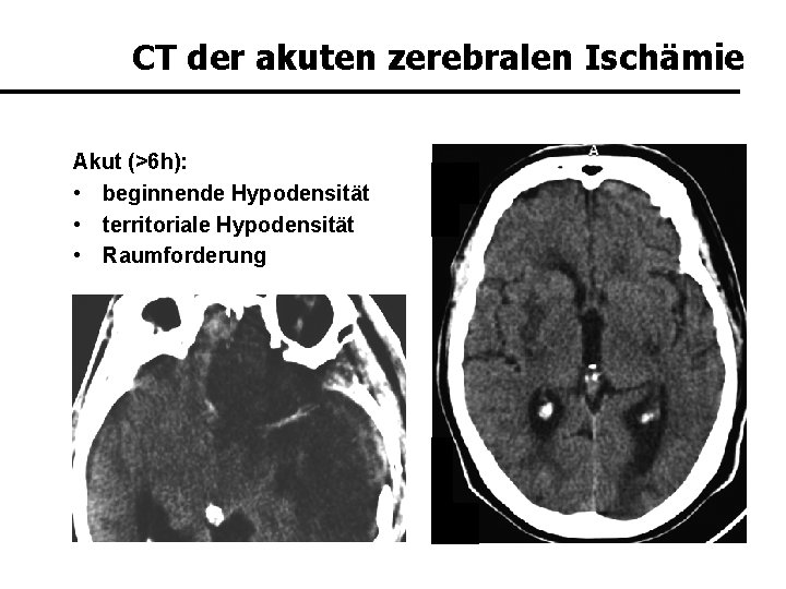 CT der akuten zerebralen Ischämie Akut (>6 h): • beginnende Hypodensität • territoriale Hypodensität