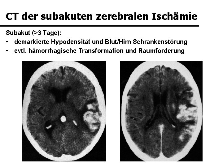 CT der subakuten zerebralen Ischämie Subakut (>3 Tage): • demarkierte Hypodensität und Blut/Hirn Schrankenstörung