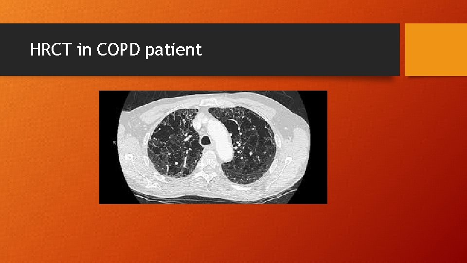 HRCT in COPD patient 