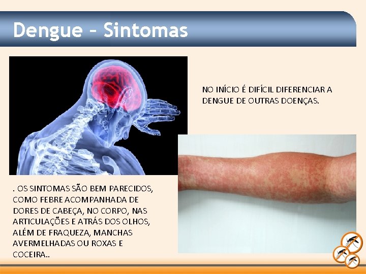 Dengue – Sintomas NO INÍCIO É DIFÍCIL DIFERENCIAR A DENGUE DE OUTRAS DOENÇAS. .