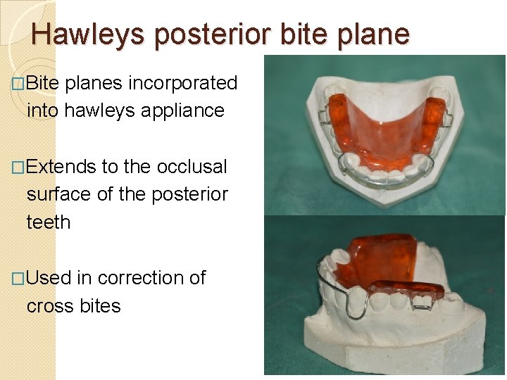 Hawleys posterior bite plane �Bite planes incorporated into hawleys appliance �Extends to the occlusal Hawleys posterior bite plane �Bite planes incorporated into hawleys appliance �Extends to the occlusal