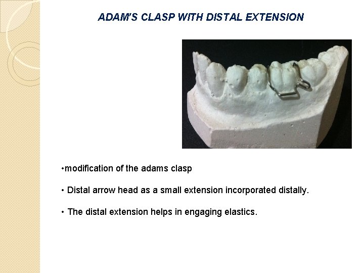 ADAM’S CLASP WITH DISTAL EXTENSION • modification of the adams clasp • Distal arrow ADAM’S CLASP WITH DISTAL EXTENSION • modification of the adams clasp • Distal arrow