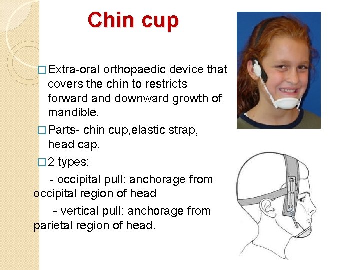 Chin cup � Extra-oral orthopaedic device that covers the chin to restricts forward and