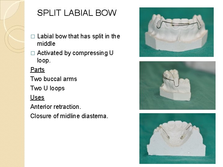 SPLIT LABIAL BOW � Labial bow that has split in the middle Activated by