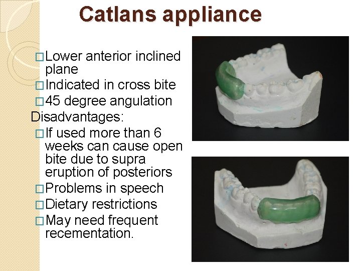 Catlans appliance �Lower anterior inclined plane �Indicated in cross bite � 45 degree angulation