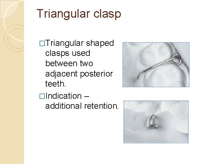 Triangular clasp �Triangular shaped clasps used between two adjacent posterior teeth. �Indication – additional