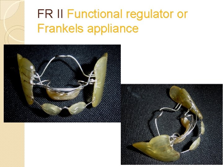 FR II Functional regulator or Frankels appliance 