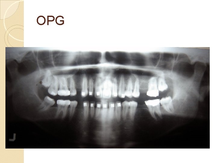 OPG OPG