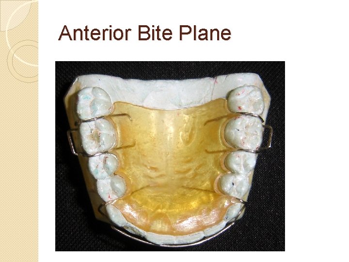 Anterior Bite Plane Anterior Bite Plane