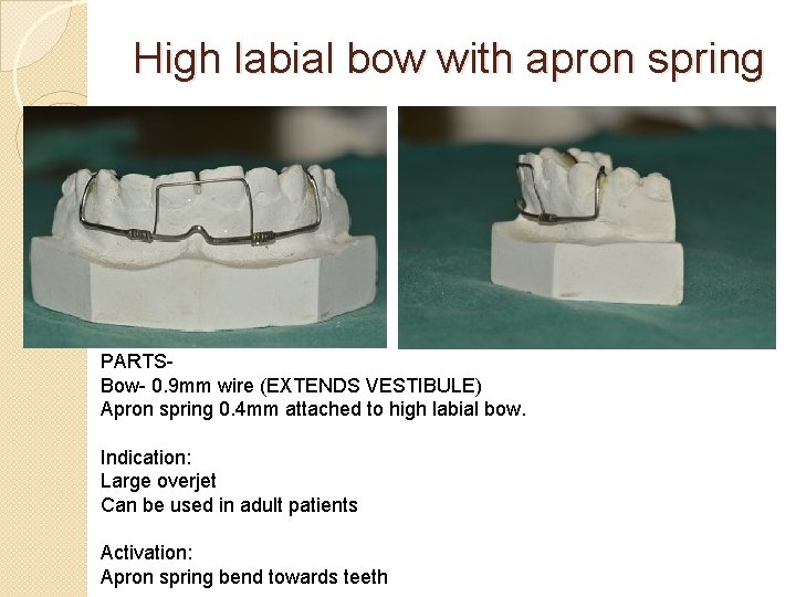 High labial bow with apron spring PARTSBow- 0. 9 mm wire (EXTENDS VESTIBULE) Apron High labial bow with apron spring PARTSBow- 0. 9 mm wire (EXTENDS VESTIBULE) Apron