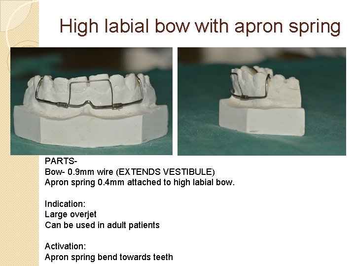 High labial bow with apron spring PARTSBow- 0. 9 mm wire (EXTENDS VESTIBULE) Apron