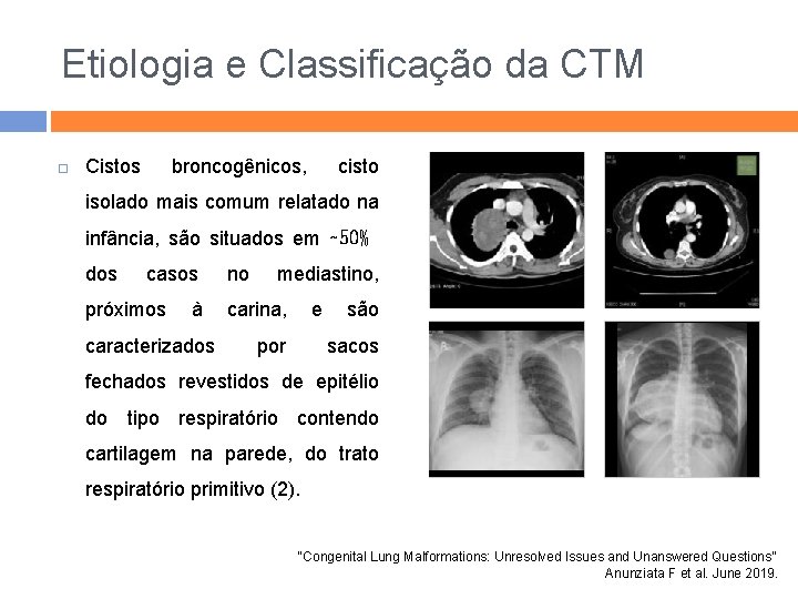 Etiologia e Classificação da CTM Cistos broncogênicos, cisto isolado mais comum relatado na infância,