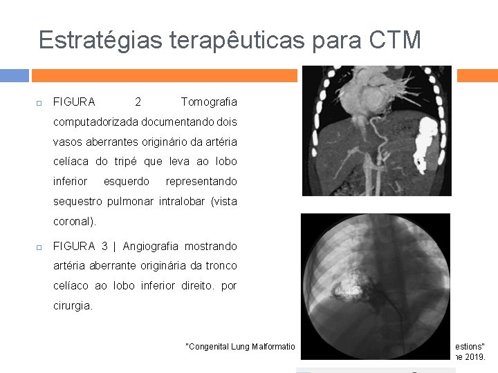 Estratégias terapêuticas para CTM FIGURA 2 Tomografia computadorizada documentando dois vasos aberrantes originário da