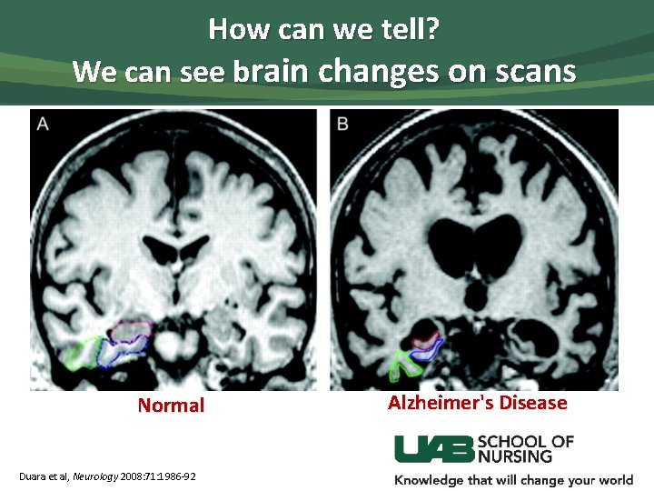 How can we tell? We can see brain changes on scans Normal Duara et