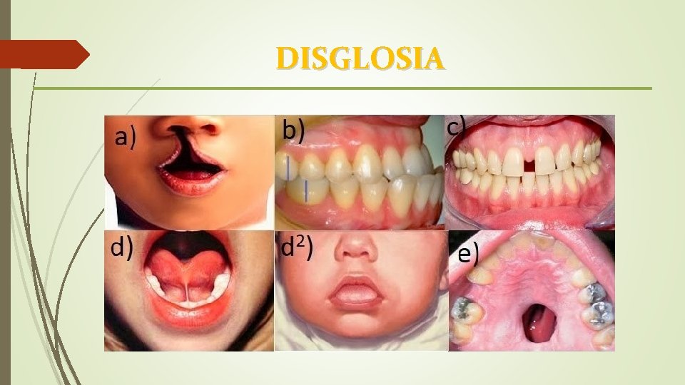 DISGLOSIA 