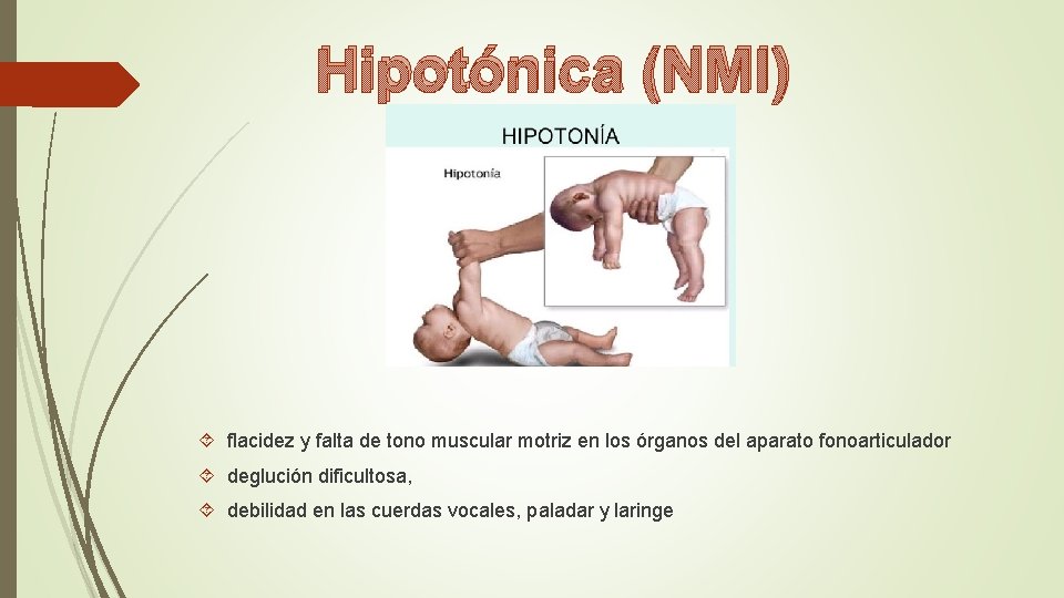 Hipotónica (NMI) flacidez y falta de tono muscular motriz en los órganos del aparato