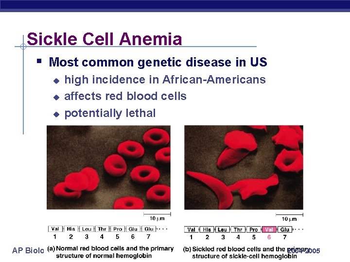 Sickle Cell Anemia § Most common genetic disease in US u u u AP