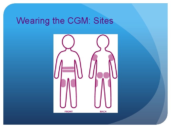 Wearing the CGM: Sites 