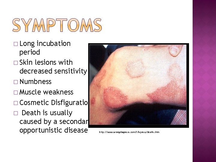 � Long incubation period � Skin lesions with decreased sensitivity � Numbness � Muscle