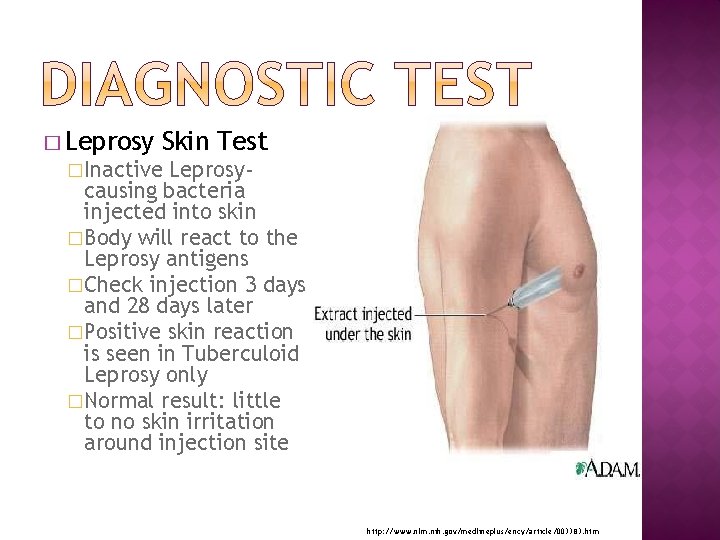� Leprosy Skin Test �Inactive Leprosycausing bacteria injected into skin �Body will react to
