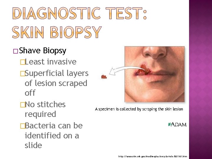 � Shave Biopsy �Least invasive �Superficial layers of lesion scraped off �No stitches required
