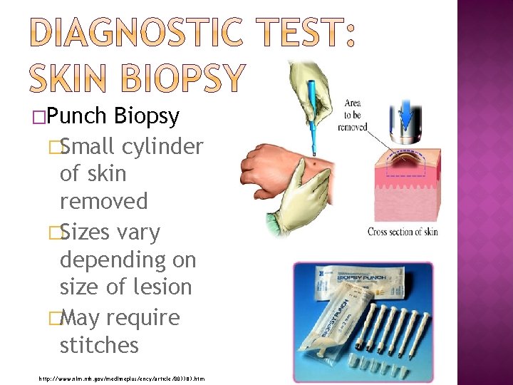 �Punch Biopsy �Small cylinder of skin removed �Sizes vary depending on size of lesion