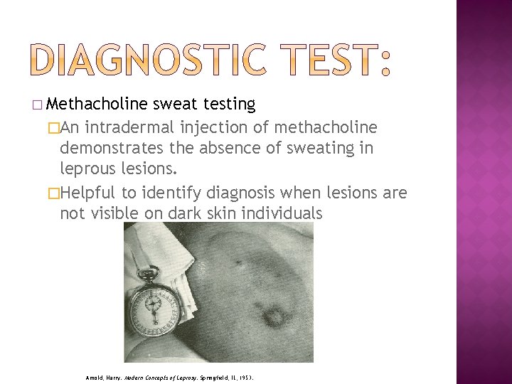 � Methacholine sweat testing �An intradermal injection of methacholine demonstrates the absence of sweating