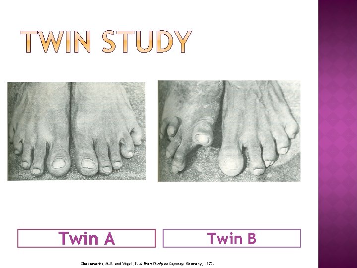 Twin A Twin B Chakravartti, M. R. and Vogel, F. A Twin Study on