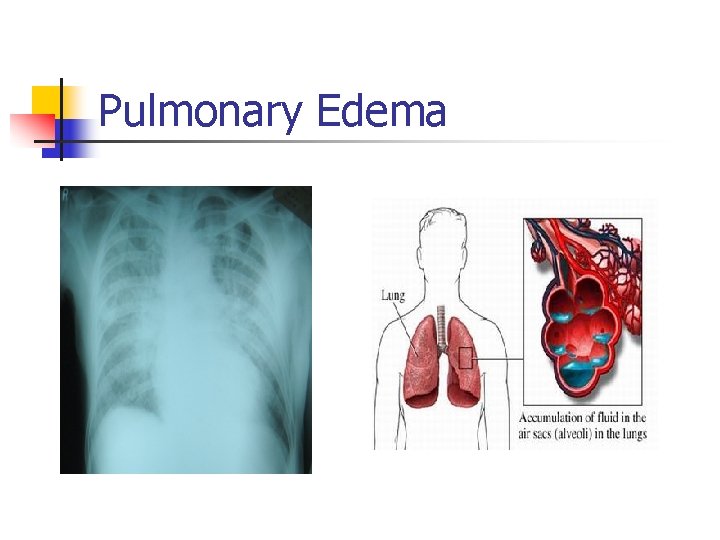 Pulmonary Edema 