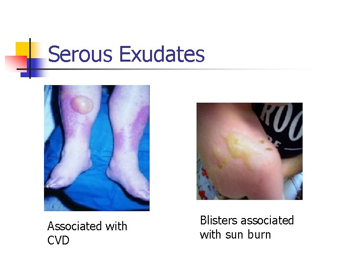 Serous Exudates Associated with CVD Blisters associated with sun burn 