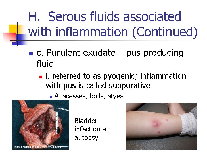 H. Serous fluids associated with inflammation (Continued) n c. Purulent exudate – pus producing