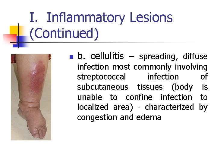 I. Inflammatory Lesions (Continued) n b. cellulitis – spreading, diffuse infection most commonly involving