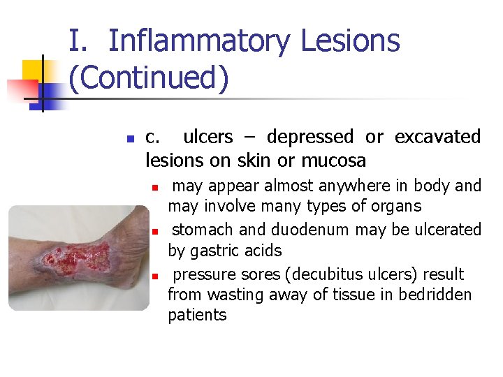 I. Inflammatory Lesions (Continued) n c. ulcers – depressed or excavated lesions on skin