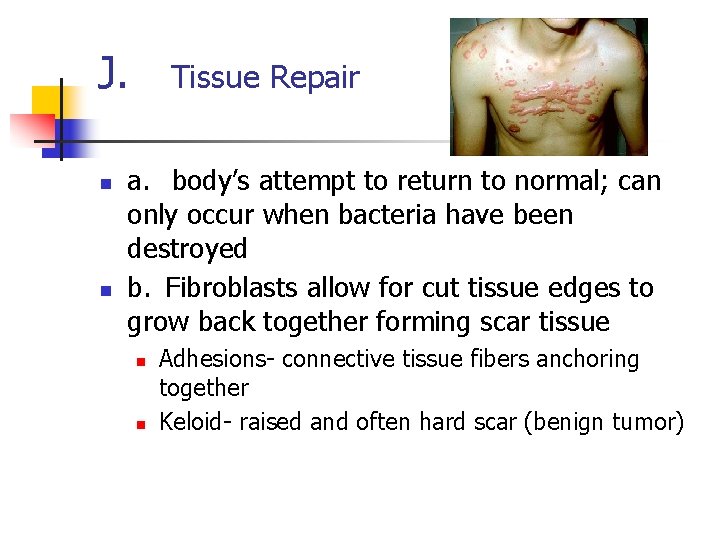 J. Tissue Repair n n a. body’s attempt to return to normal; can only