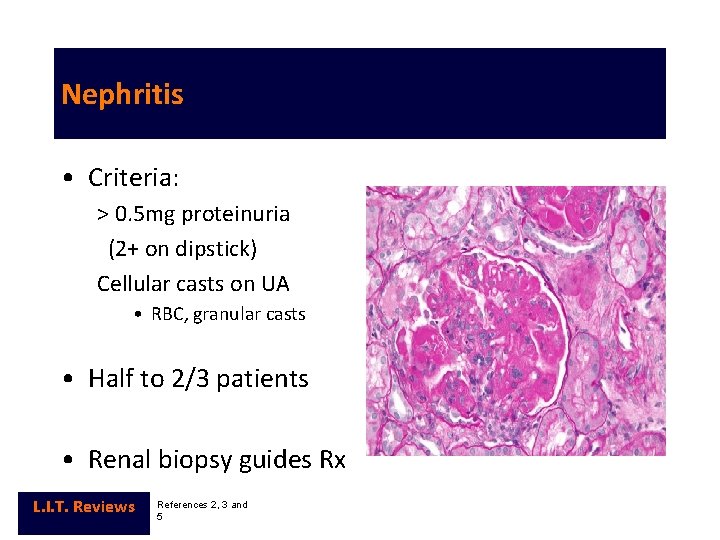 Nephritis • Criteria: > 0. 5 mg proteinuria (2+ on dipstick) Cellular casts on