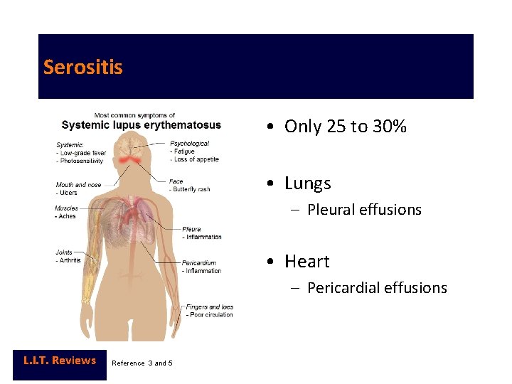 Serositis • Only 25 to 30% • Lungs – Pleural effusions • Heart –