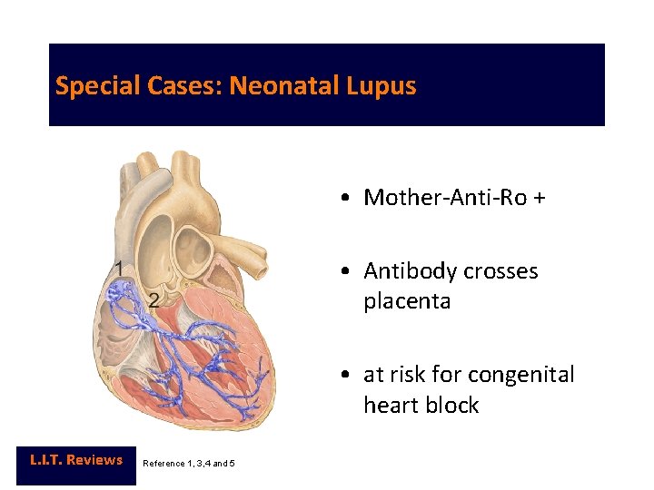 Special Cases: Neonatal Lupus • Mother-Anti-Ro + • Antibody crosses placenta • at risk