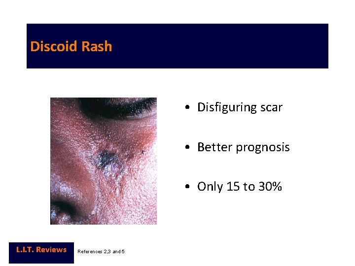 Discoid Rash • Disfiguring scar • Better prognosis • Only 15 to 30% L.